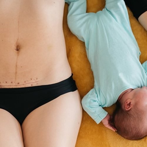 Cesarean (C-Section) Delivery